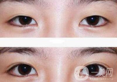 全切雙眼皮術后吃什么？術后如何護理