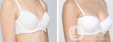 隆胸手術(shù)后多久恢復(fù)？術(shù)后注意事項有哪些