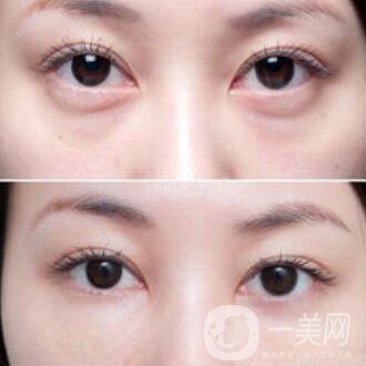 激光去眼袋的副作用 需要如何處理