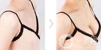 自體隆胸后多久可以上班？術(shù)后有哪些注意事項(xiàng)