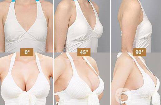 隆胸取出醫(yī)院介紹？隆胸取出后應(yīng)該要注意什么