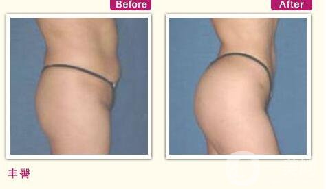 深圳,自體脂肪豐臀,價(jià)格