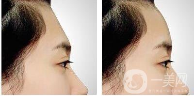 墊額頭手術(shù),有哪些注意事項