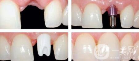 種植牙是怎么操作的？種植牙的過程