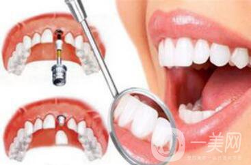 深圳種植牙手術(shù)價(jià)格大概是多少？