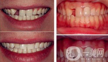 深圳種植牙手術(shù)價(jià)格大概是多少？