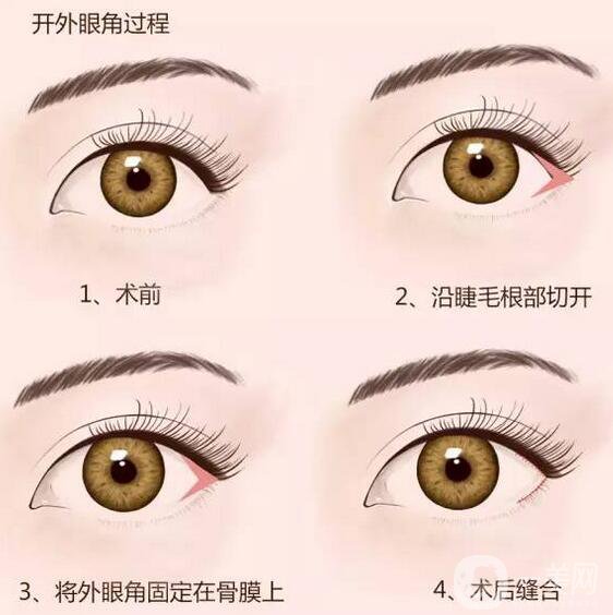 開眼角*果怎么樣？手術(shù)風(fēng)險大不大