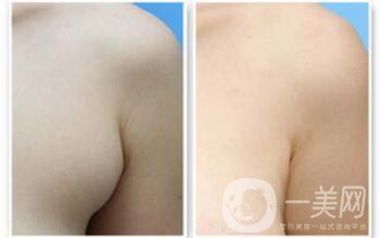 副乳是什么？副乳切除手術(shù)需要多久