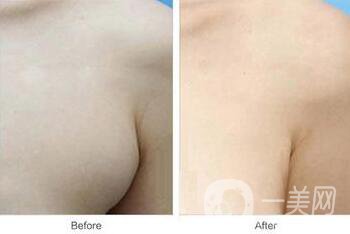 副乳是什么？副乳切除手術(shù)需要多久