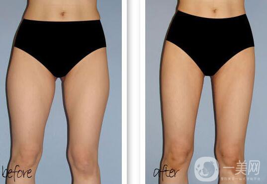 大腿吸脂多久恢復(fù)？大腿吸脂后遺癥有哪些