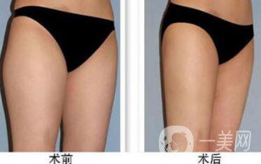 大腿吸脂多久恢復(fù)？大腿吸脂后遺癥有哪些