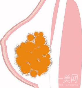 取出乳房奧美定*果怎么樣？取出*嗎？