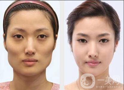 磨顴骨手術(shù)之后容易有后遺癥么？主要有哪些情況？