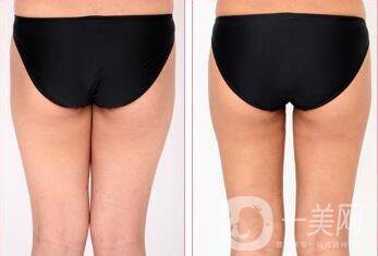 磨顴骨手術之后容易有后遺癥么？主要有哪些情況？