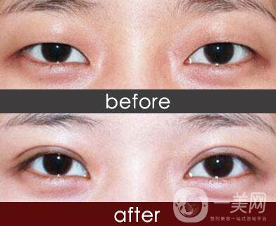 做完埋線雙眼皮手術(shù)需要注意什么