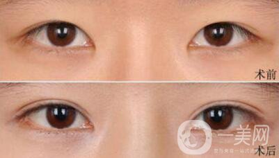 做完埋線雙眼皮手術(shù)需要注意什么