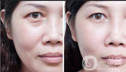 臉上長法令紋怎么才能祛除 方法介紹