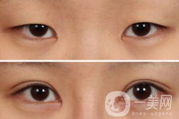 雙眼皮手術(shù)有哪些方法？做雙眼皮前要準(zhǔn)備什么