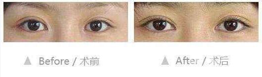 開(kāi)眼角,適宜人群