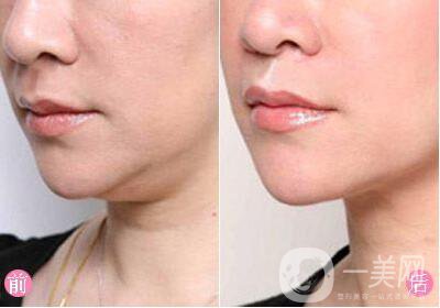 光纖溶脂去雙下巴多少錢(qián)？