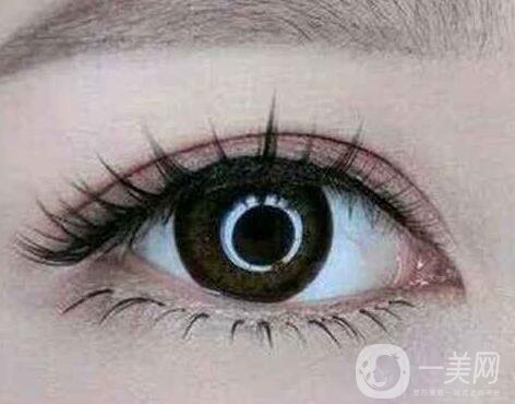 埋線雙眼皮之后禁口嗎？