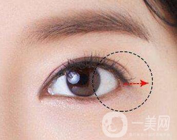 開(kāi)眼角需要注意些什么？