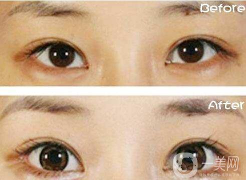 深圳,上瞼下垂矯正,多少錢呢