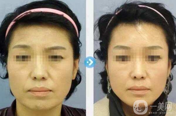 北京,面部提升,多少錢