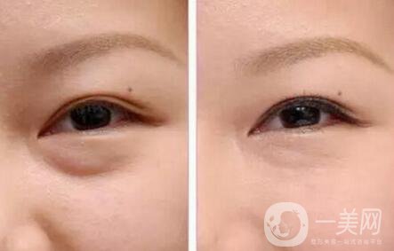 內(nèi)切祛眼袋術后護理主要有哪幾點？