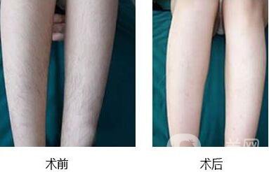 北京,激光脫毛,多少錢