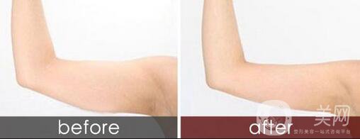 吸脂瘦手臂*果怎么樣 手術(shù)*嗎