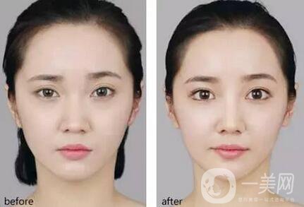 開外眼角術(shù)前注意事項主要有哪幾點？