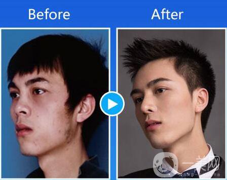 第二次隆鼻多久修復(fù)？隆鼻修復(fù)多久才可以做？