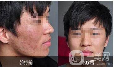 復合彩光祛痘印,注意事項