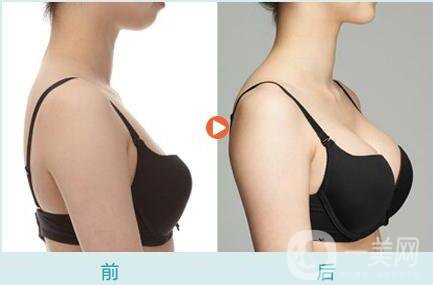 自體脂肪隆胸后多久可以恢復(fù)上班？