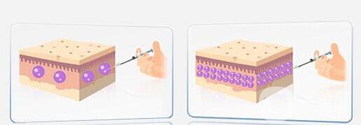 自體脂肪隆胸后多久可以恢復(fù)上班？