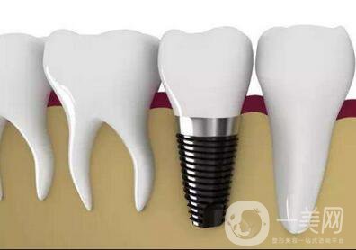 登騰在醫(yī)院轉(zhuǎn)做種植牙需要多少錢 價格影響因素有哪些