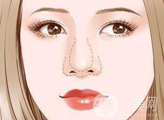 怎么縮小鼻翼？縮小鼻翼術后護理