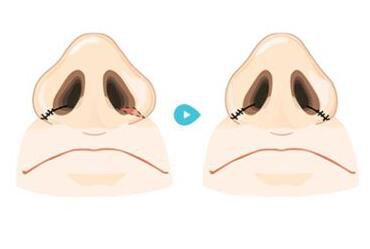 鼻翼縮小術(shù)是*的嗎？