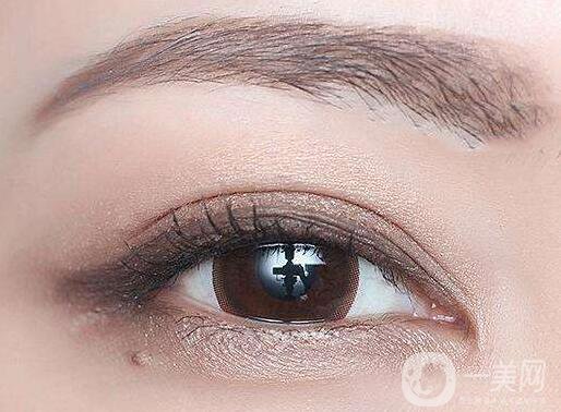 全切雙眼皮能維持多久？