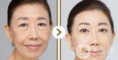 塑美極*果怎么樣？塑美極的副作用