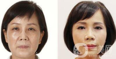 塑美極*果怎么樣？塑美極的副作用