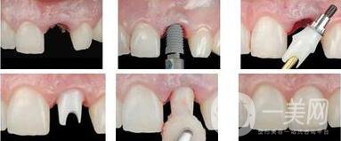 廣州做種植牙價多少錢？費用高嗎