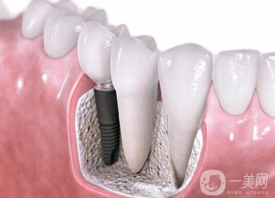 廣州做種植牙價多少錢？費用高嗎