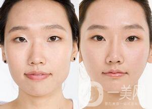 硅膠隆鼻手術(shù)失敗之后假體取出怎么辦