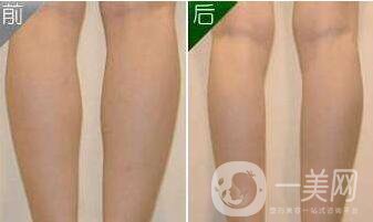 上海,抽脂瘦小腿,價格