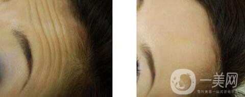 *注射去皺多久見*