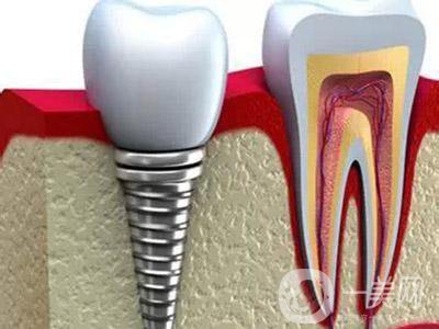 北京種植牙多少錢 種植牙過程和原理