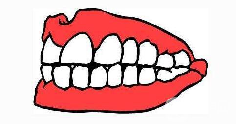 貴金屬烤瓷牙,全瓷牙