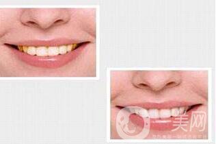 貴金屬烤瓷牙,全瓷牙